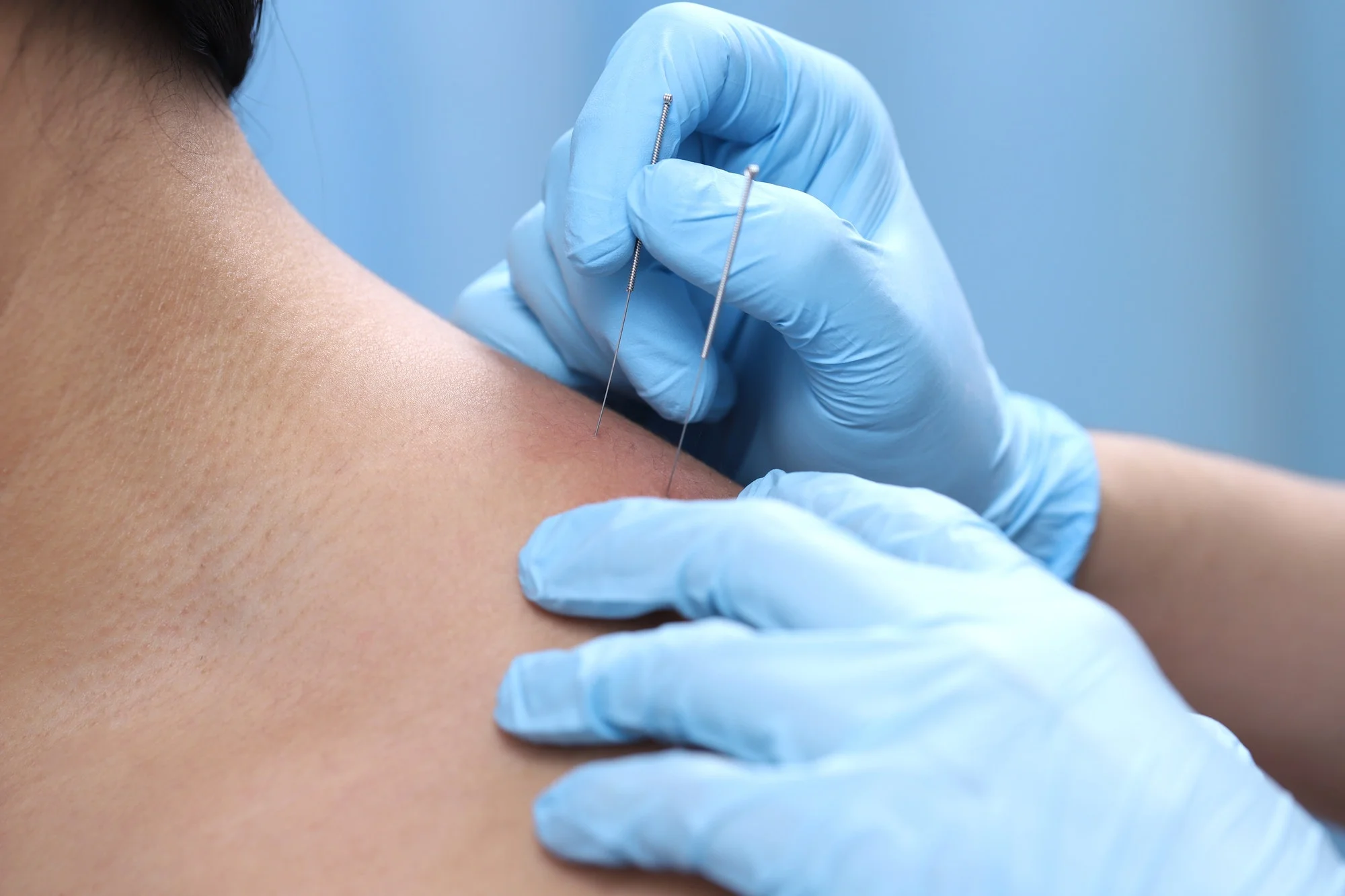 Acupuncture with needles in the shoulder