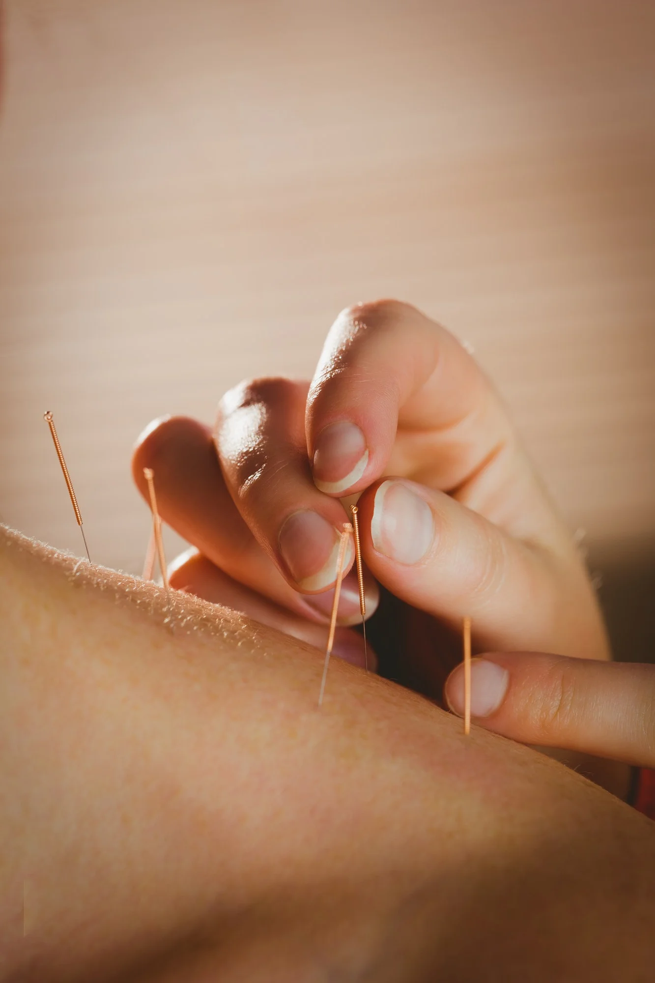 Young woman getting acupuncture treatment in therapy room